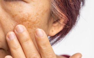 Melasma o que é, causas, tipos e como identificar