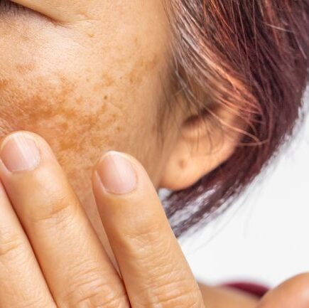 Melasma o que é, causas, tipos e como identificar