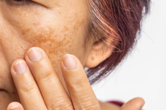 Melasma o que é, causas, tipos e como identificar