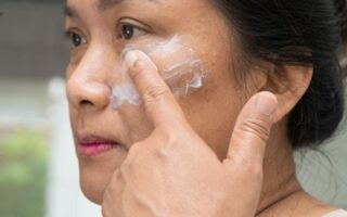 Melasma e protetor solar como escolher e usar corretamente