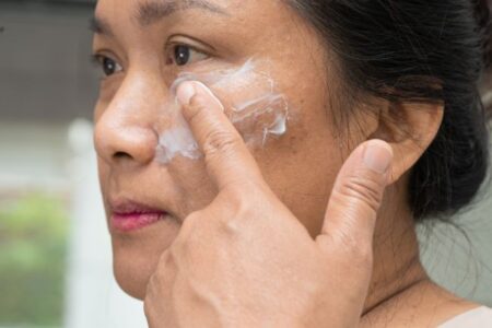 Melasma e protetor solar como escolher e usar corretamente