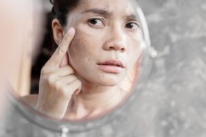 Melasma hábitos e cuidados que ajudam a controlar as manchas