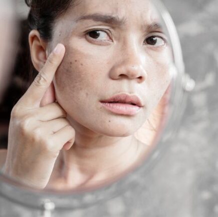 Melasma hábitos e cuidados que ajudam a controlar as manchas